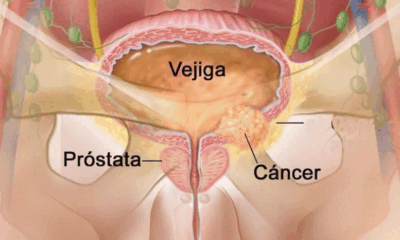 El 5 de Mayo Día internacional del Cáncer de Vejiga